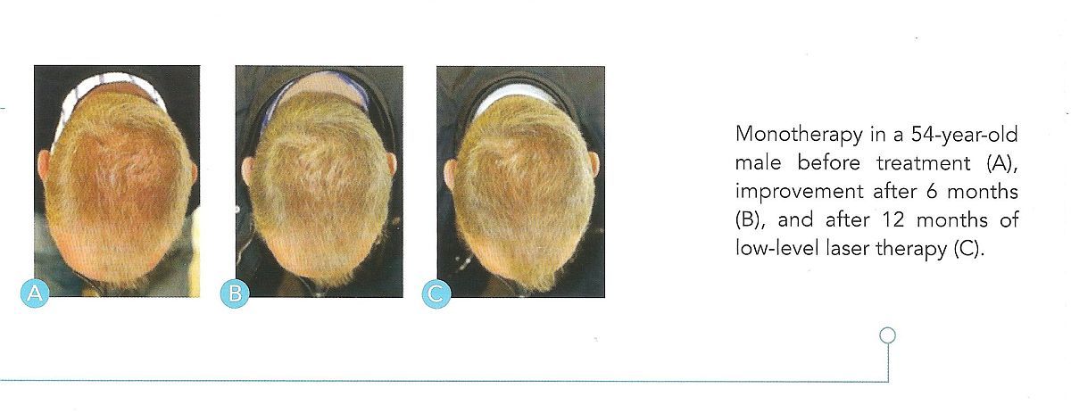 LLLT and Minoxidil Hair Regrowth Results LLLT laser therapy, Minoxidil and oral finasteride hair growth clinical study on male