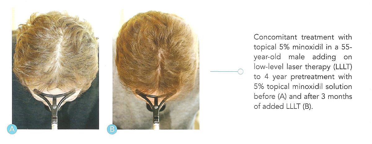 Low Laser Therapy Hair Regrowth Results LLLT laser therapy hair growth clinical study on male