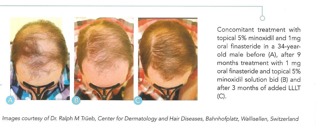 Low Laser Therapy Hair Regrowth Results LLLT laser therapy, Minoxidil and oral finasteride hair growth clinical study on male