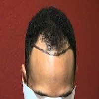 preparing for Scalp micropigmentation