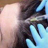 Plasma Rich Platelet ScalpTreatment