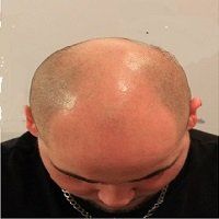 man with male pattern baldness