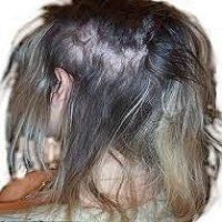 traction Alopecia female hair loss