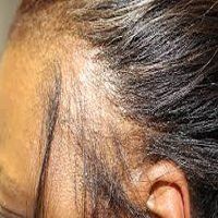 traction-alopecia-afro-hair