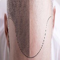 smp technique before and after