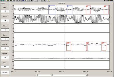 Cheyne Stokes Atmung Cheyne Stokes Atmung