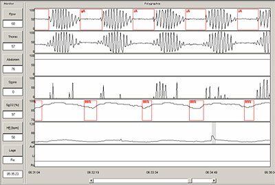 Zentrales Schlafapnoesyndrom Zentrales Schlafapnoesyndrom