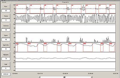 Schlafapnoesyndrom Schlafapnoesyndrom