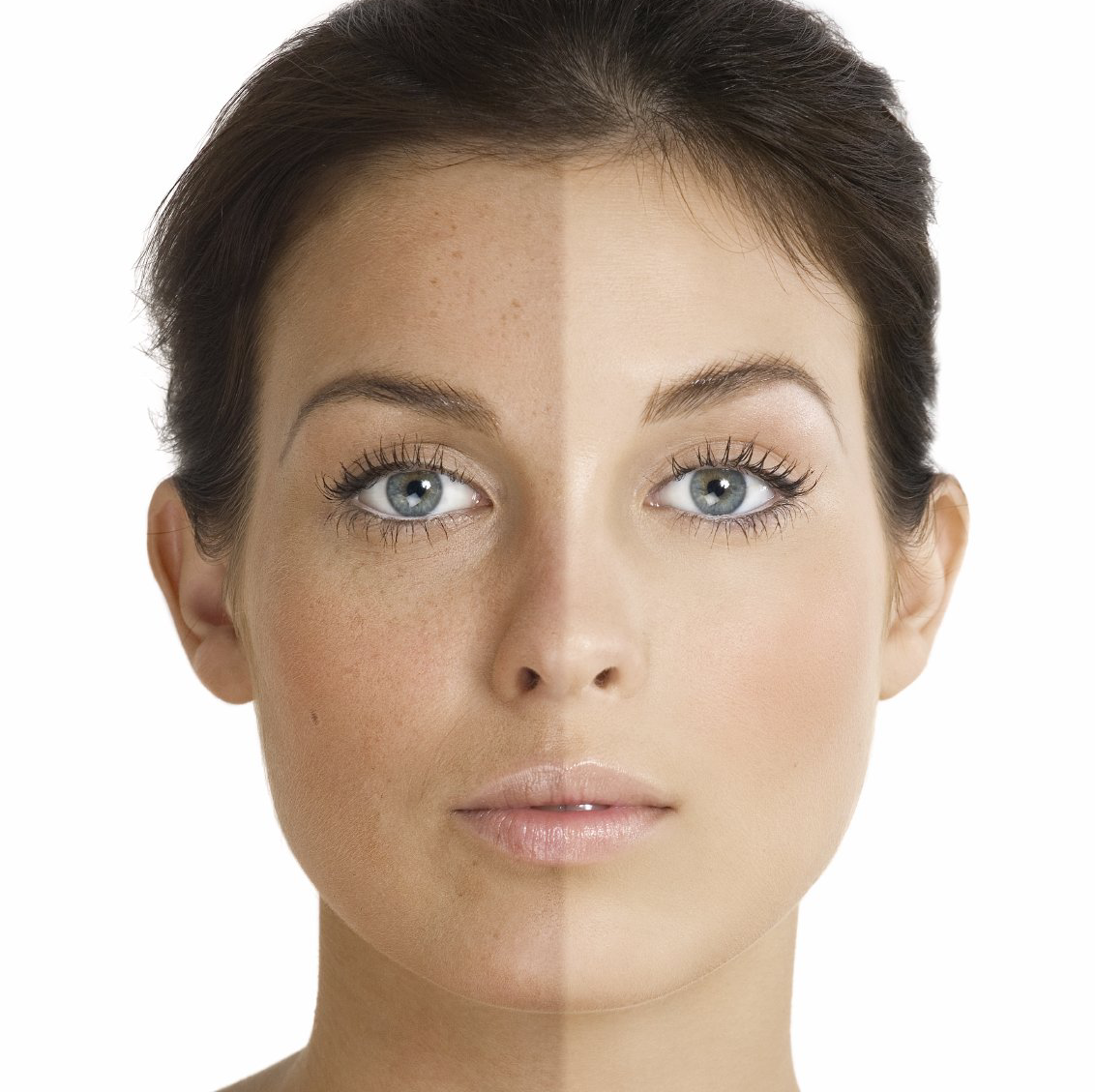 Eine Faltenbehandlung mit Botox und Filter erfolgt zumeist schmerzfrei und bietet sehr gute Ergebnisse. Botox in Rostock.