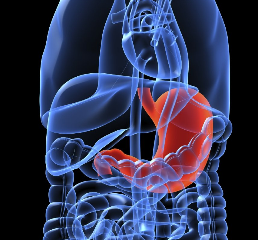 Diferencias entre hernia de hiato y reflujo gastroesofágico (RGE)