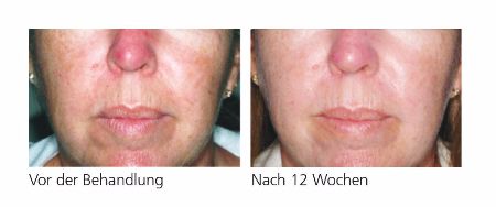 PyratineXR – Reduziert Rötungen in nur 12 Wochen. PyratineXR – Vorher-Nachher-Bilder nach 12 Wochen zeigen deutliche Verbesserung der Hautqualität und reduzierte Rötungen.
