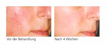 PyratineXR – Reduziert Rötungen in nur 4 Wochen. PyratineXR – Vorher-Nachher-Bilder nach 4 Wochen zeigen deutliche Verbesserung der Hautqualität und reduzierte Rötungen.