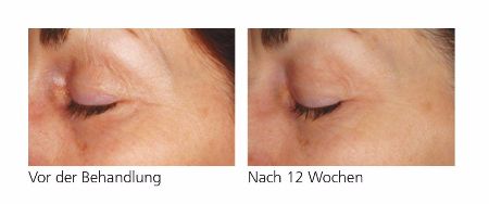 PyratineXR – Reduziert sichtbar Rötungen in nur 12 Wochen. PyratineXR – Vorher-Nachher-Bilder nach 12 Wochen zeigen deutliche Verbesserung der Hautqualität und reduzierte Rötungen.