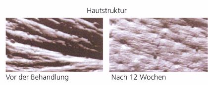 PyratineXR verbessert sichtbar die Hautstruktur. PyratineXR – deutliche Verbesserung der Hautstruktur, vergrößert dargestellt.