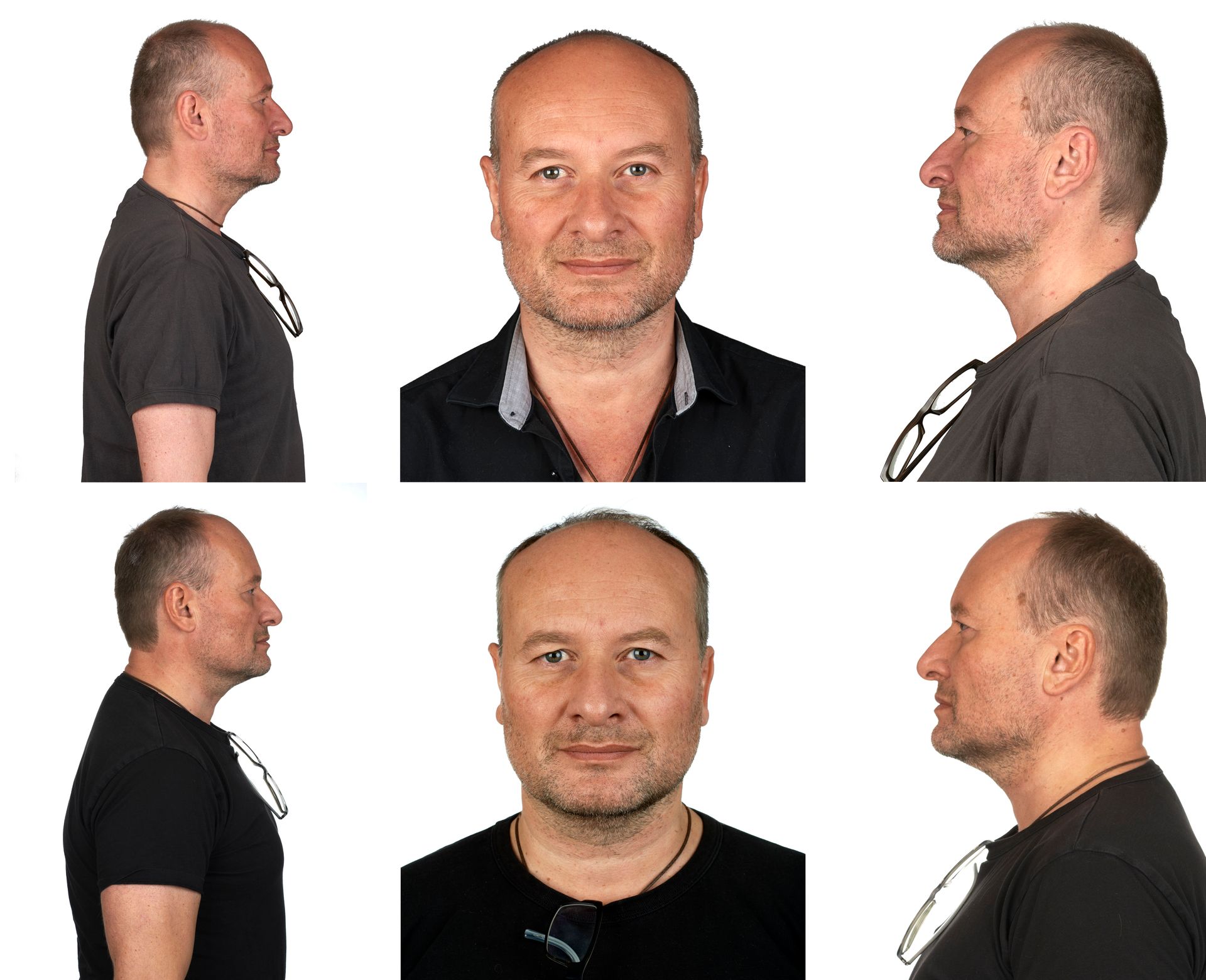 Sogar die Kopfform kann sich ändern. © LichtBildLink Ingolstadt
Ein ausgeprägtes oberes Hinterhaupt steht in der Psycho-Physiognomik für ein starkes Selbstbewusstsein. Einhergehend mit Christians innerem Entwicklungsprozess dokumentiert diese Fotoserie die Transformation seiner Kopfform innerhalb von sechs Jahren.