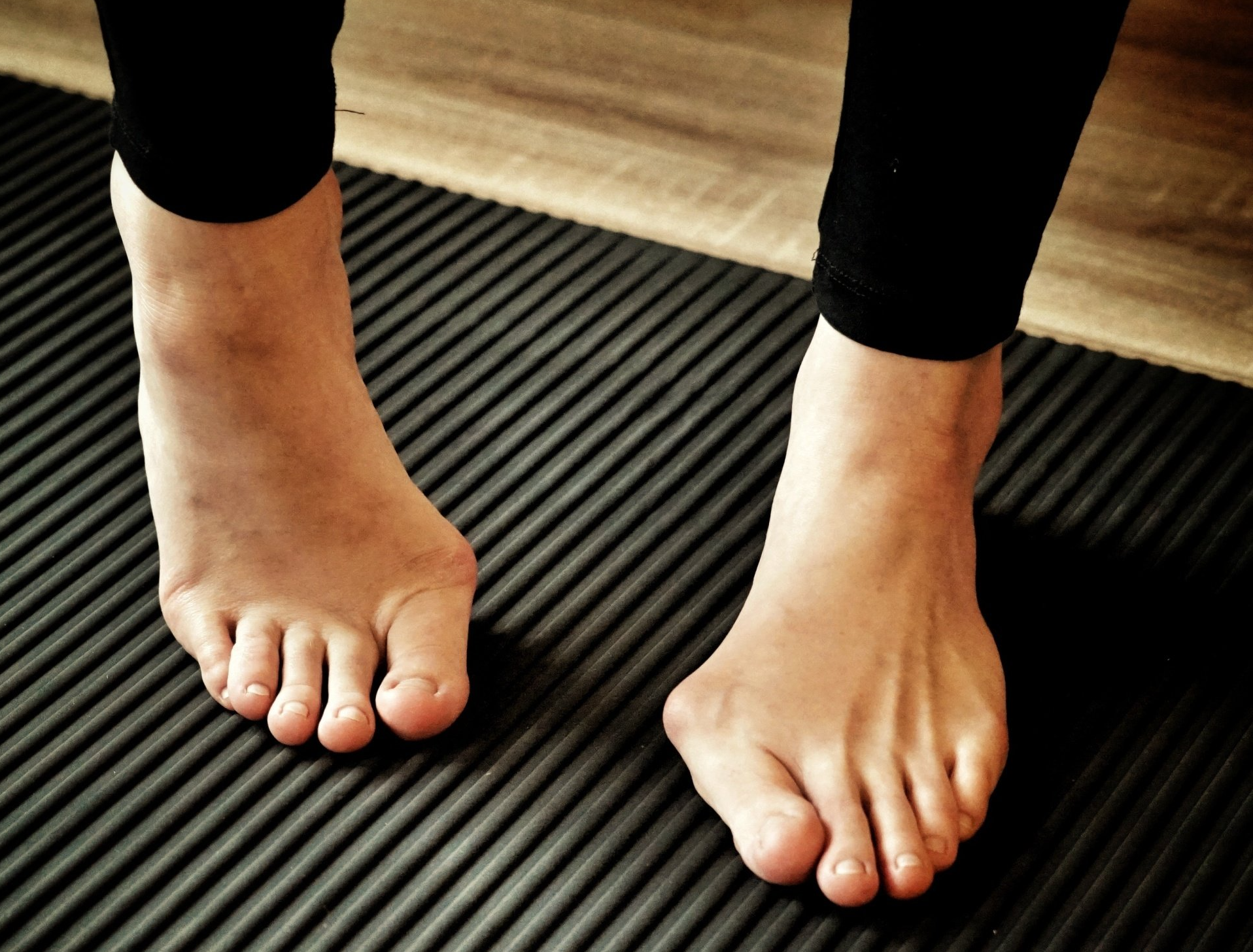 Hallux Valgus bekämpfen