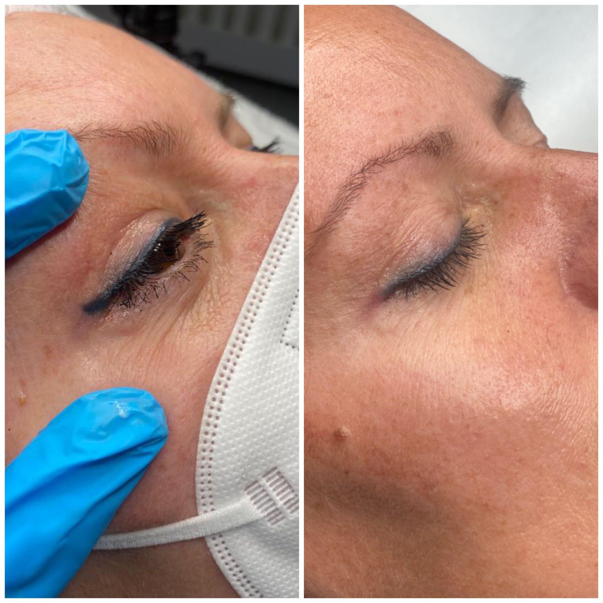 Tattooentfernung Entfernung Permanent Make Up Remover