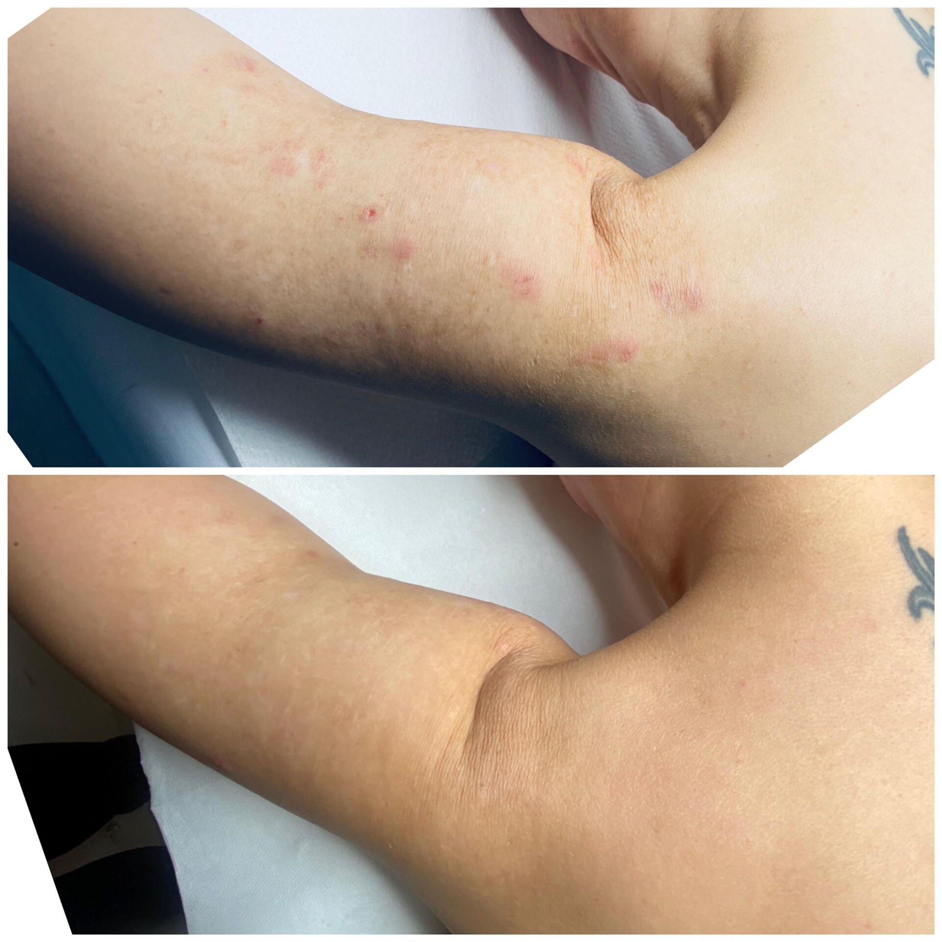 Narbenkorrektur, Aknenarben, Narbencamouflage, medizinische Pigmentierung