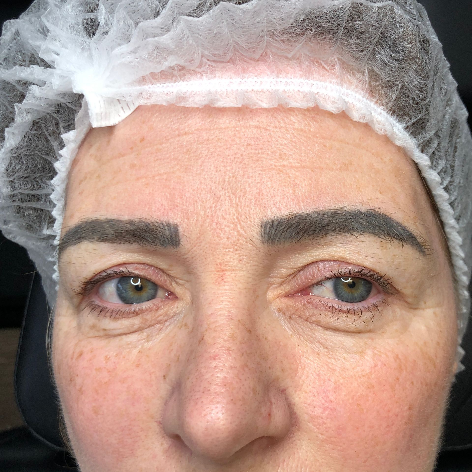 Blue eyebrows before laser removal
