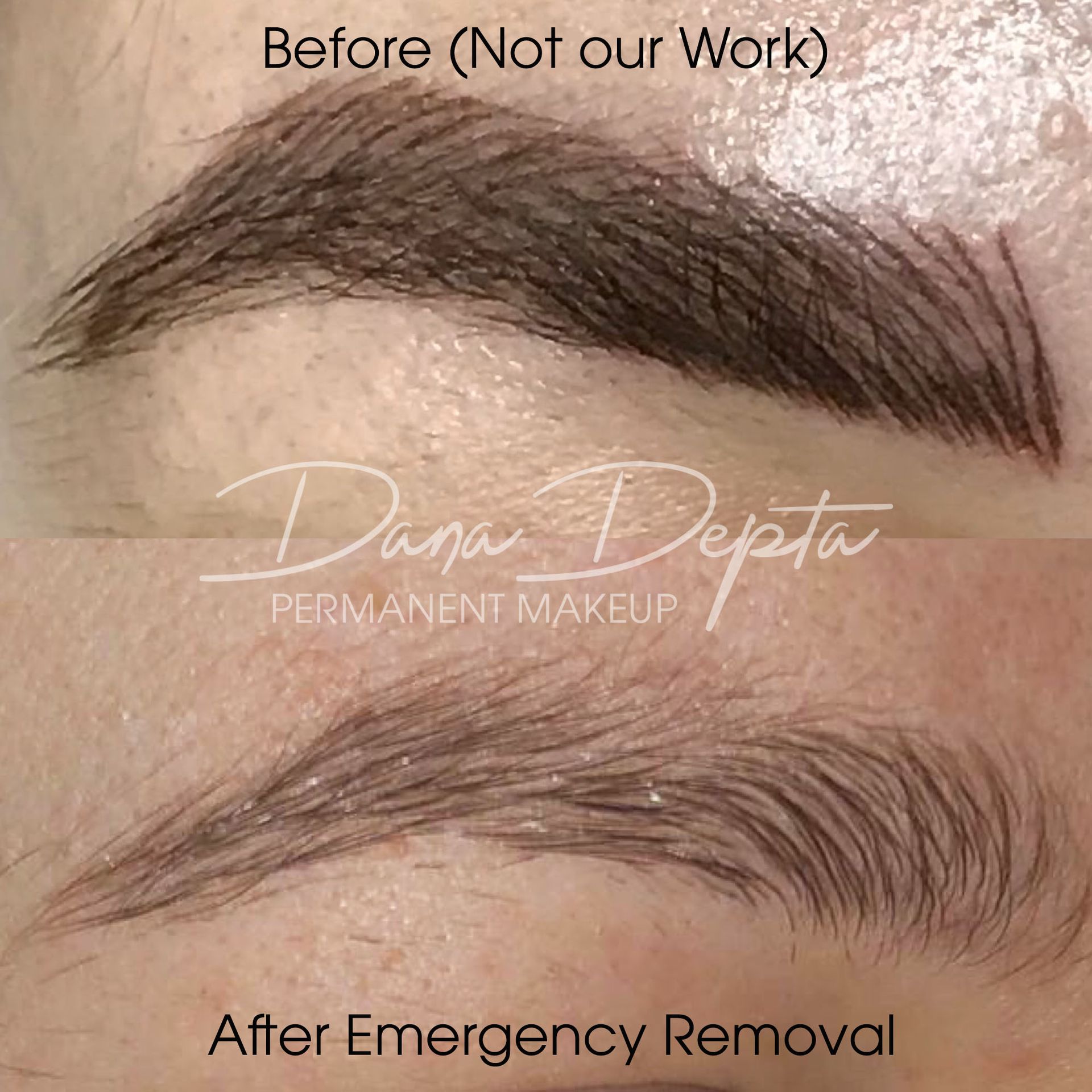 Microblading removal London
