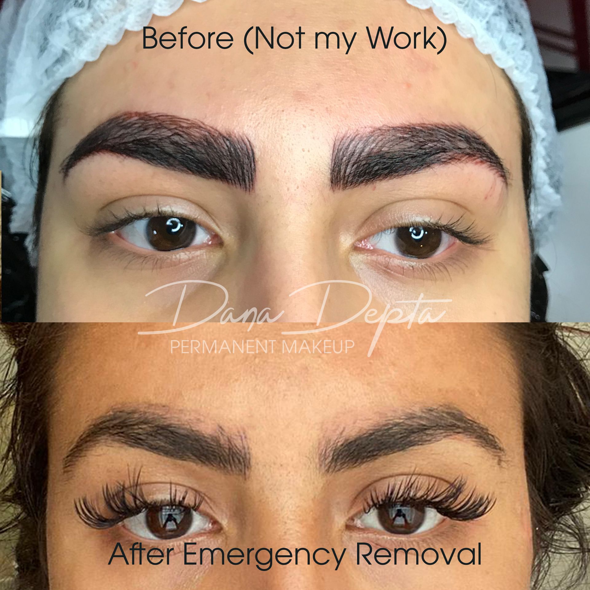Botched eyebrows removal before and after