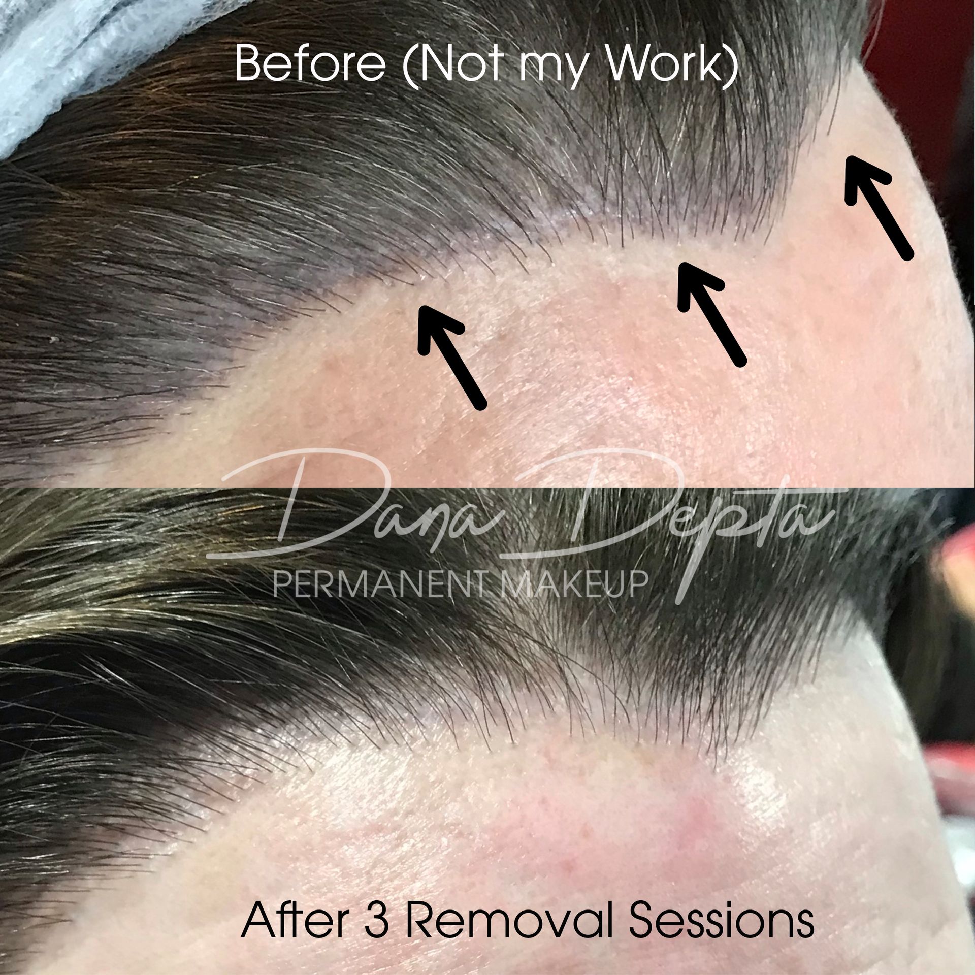 Scalp micropigmentation removal done by Dana Depta Permanent Makeup, London