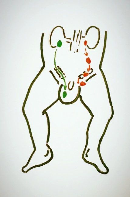Hodenhochstand - grün normaler Weg des Hodens in der Embryonalphase , rot:mögliche Fehllage des Hodens bei gestörtem Abstieg des Hodens Hodenhochstand