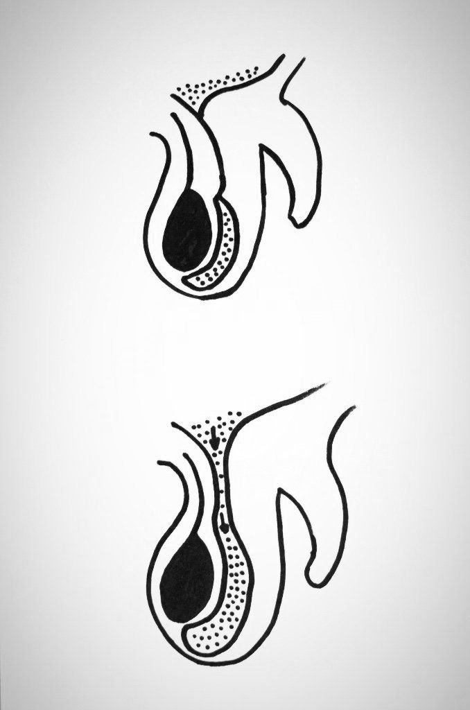 Hydrozele / Wasserbruch                                                    oben: normal verschlossener Kanal zwischen Bauchfell und Hoden                                        unten: offener Kanal zwischen Bauchfell und Hoden ( offener Prozesses vaginalis)