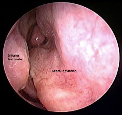 Déviation de la cloison nasale