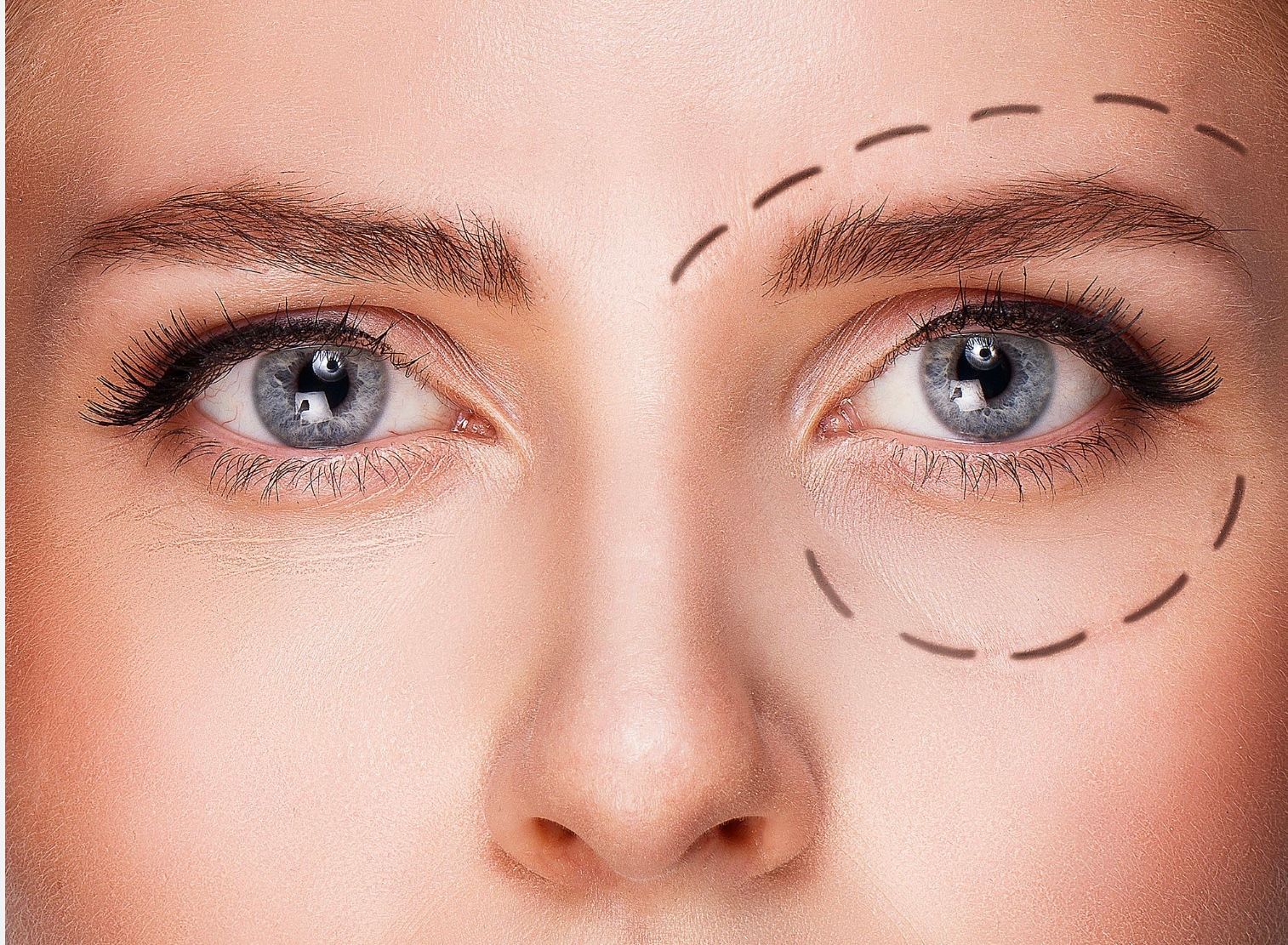 Blépharoplastie Dr Eric BONAFOS  Blépharoplastie Dr Eric BONAFOS Montpellier