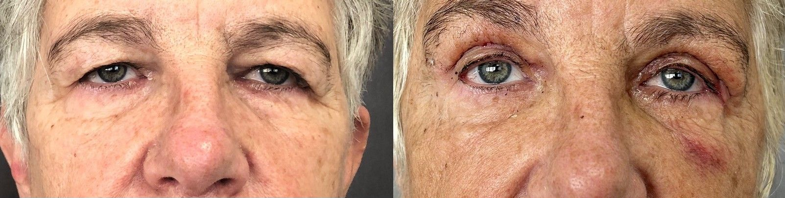 Blépharoplastie supérieures ablation des points à5 jours