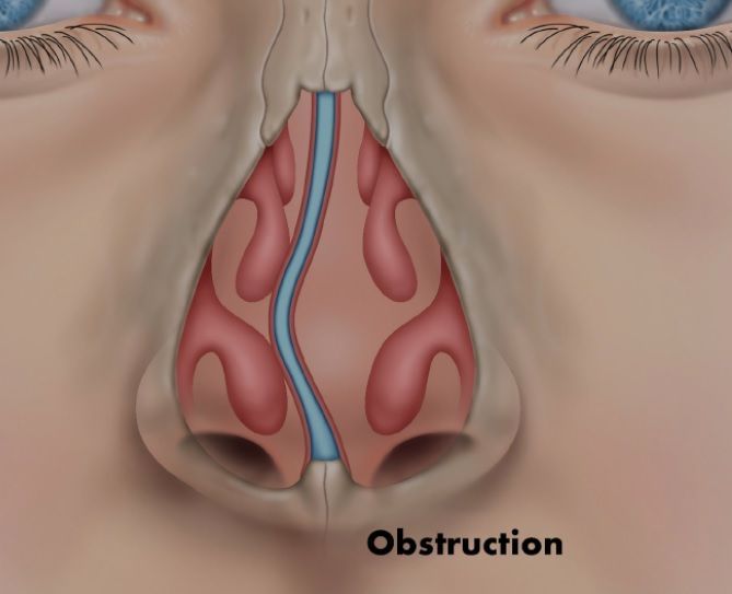 Déviation de la cloison nasale Déviation de la cloison nasale
